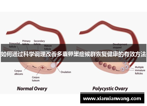 如何通过科学调理改善多囊卵巢症候群恢复健康的有效方法