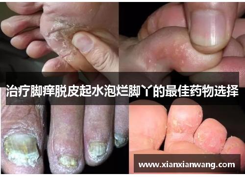 治疗脚痒脱皮起水泡烂脚丫的最佳药物选择